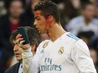 Криштиану Роналду прямо на поле осматривал свое кровавое личико, брав телефон у доктора «Реала»(фото)